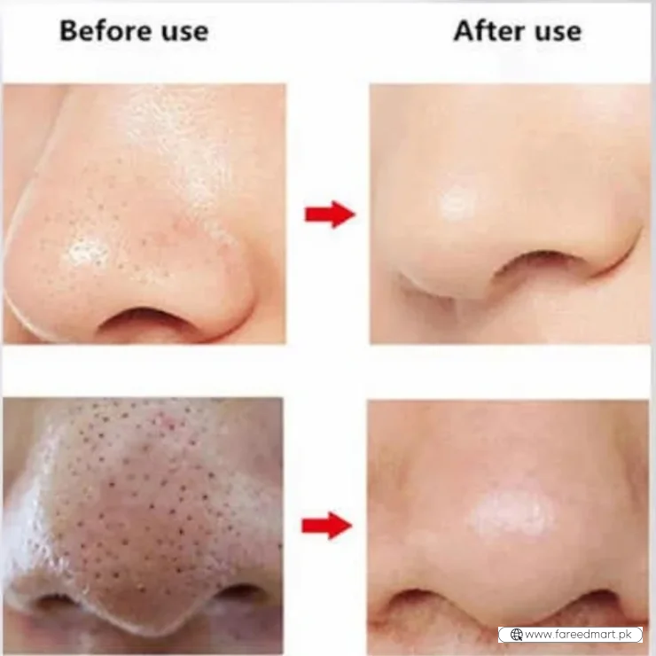 Rechargeable Blackhead Remover Vacuum Cleaner | Model FPLS-001 | Deep Pore Cleansing & Microdermabrasion Device