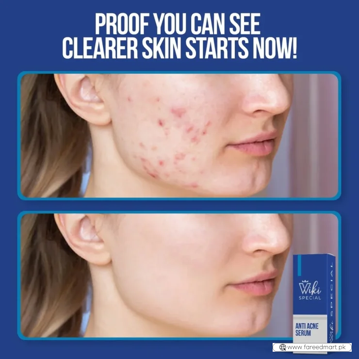Wiki Special Anti Acne Serum 30ml | Clears Acne & Soothes Skin